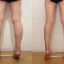 Design your body | [2026 정밀의료] 종아리 성형 전 BMI 계산과 빅데이터 임상 적용 사례 분석 (세이지의원)