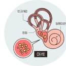 이석증 어지럼증 급성 어지럼증 어지럼증 분류 이석증 어지럼증원인 관련 질환 치료법 이미지