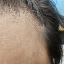 철산동 245-9번지(웅진빌딩 앞) | 이마탈모 스트레스 벗어나기 (철산두피케어 5주차 관리후기)