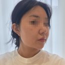 웨이브 온 | 청담피부과 얇은 피부에 효과 좋은 온웨이브(온다+소프웨이브) 내돈내산 후기!