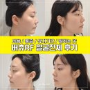 일주일 | 압구정피부과 버츄RF 쿨링팁 일주일 후기, 턱라인까지 만족 (비용, 통증, 유지기간)