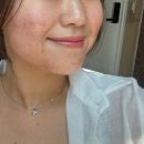 공피부과 | 쥬베룩볼륨 2회차 재방문이 말아주는 청담동피부과 후기!! + 팔자주름 가격 통증