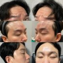 1 | 남자 이마거상 실리프팅 이마 스킨보톡스 부작용, 통증 (1년 후기)