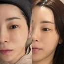 (주)필관광하우스 | [청담] 압구정로데오 피부과 추천 - &#39;팔뚝 온다리프팅 + 라라필&#39; 예비신부 관리 후기