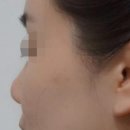 10 | 부천 상동 코실리프팅 + 콧대 자연스럽게 높아진 리얼 후기