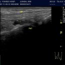 Erosive changes in subchondral bone 이미지