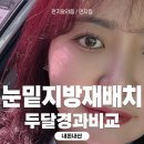 신사역 눈밑지방재배치 두달경과, 전후비교사진 내돈내산 후기