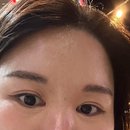 이상열 | 용산 우리연세안과 안검내반 성인 수술 과정 후기