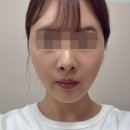드림피부과의원 | 청담피부과) 청담안느의원 ANNE - 강남 청담 실리프팅 후기 내돈내산