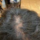 펫아울렛(수영강변점) | 바람 불어도 당당하게! 엠자/정수리 탈모 완벽 커버, 르네시떼미용실 토탈탈모커버성형펌 리얼 후기