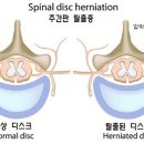 통증-허리/목 디스크, 척추관협착증 자연요법 이미지