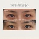 뒤트임 밑트임 비절개 강남 훌륭 성형외과 뒤밑트임 후기