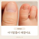 미올린의원 | 솔루엠사옥 미올린의원 방문후기 | 16개월 아기 발톱 깨짐·내성발톱 진료