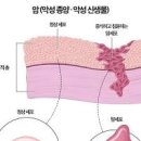 백혈병 혈액암 초기증상 이상 신호 3기 4기 완치율 이미지