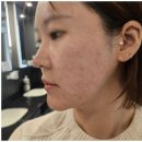 청담밴스의원 | 리쥬란힐러 청담밴스의원 내돈내산 만족후기