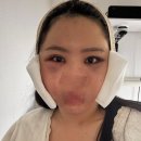 안면가스 - 17890 | 광대 축소 안면윤곽 후기(1종)_1~2일차