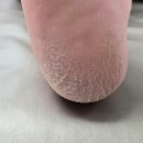 골드발관리화장품 | [관악 약손골드] 신림 발각질관리 티눈제거 후기 드디어 문제성 발관리 장인을 만났습니다
