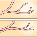 동맥색전증 및 혈전증(Arterial embolism and thrombosis) 순환기질환이란? 이미지