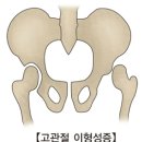 고관절 이형성증 (DDH ,developmental dysplasia of the hip) 이미지