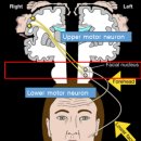 맑고고운라벨라의원 | 중추성 안면마비와 말초성 안면마비 -1