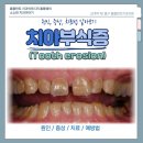 상아플란트치과 | 치아부식증(Tooth erosion) 원인, 증상, 치료방법