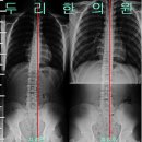 15세 운동을 열심하는 고등학생에게 발생한 측만증 치료예 이미지