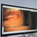 다나을약국 | 다래끼 약국 약으로 치료 수술 없이 해결한 후기