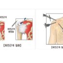 회전근개증후군에 대해서 알아볼까요? 이미지