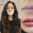 밴스의원 | # 화곡역 밴스 의원 _ 내돈내산 입술 필러 및 입꼬리 보톡스 이벤트 비용 실제 후기 일지 기록
