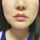 드올의원 | 신사역 드올의원 팔자주름 실리프팅 솔직후기