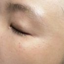 한빛한의원 | 23년만에 아토피로부터 벗어난 방법(아토피 박멸 일지)