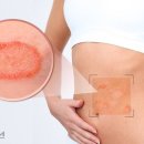 장미반점 이미지