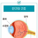 비문증과 망막박리 이미지