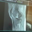 미주테라피 | [1주차]전방십자인대 완파/내측측부인대 완파/무릎뼈미세골절/연골판손상 후기
