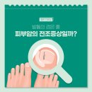 발톱의 검은 줄, 피부암의 전조증상일까? 이미지