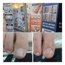 코디풋네일 | 내성발톱 재교정 from코디풋네일