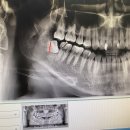 민지학치과의원 | 사랑니 발치_민지학 치과의원_부산 연제구,수영구,안락,센텀치과