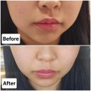 울트라 짐 | 명동역 울쎄라보다 효과 본 울트라인 400샷 내돈내산 후기