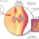 통풍초기 통풍에 좋은음식 안좋은음식 통풍 원인 이미지