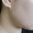 예스약국 | 편평사마귀 부작용 흉터 관리 후기 2탄(노스카나, 비타민c, 예스크림 등)