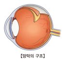 망막 열공(retina tear) 눈 질환이란? 이미지