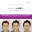 4 | M자 · 넓은이마 고민 20대 여성 모발이식 4주차 후기