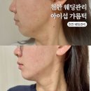천안 윤곽관리 아이섭 갸름턱 1회 이중턱 리프팅 솔직 후기 신부관리 추천