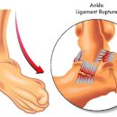 발목 안쪽 바깥쪽 앞쪽 뒤 통증 & 복숭아뼈 아래발목통증 원인 이미지