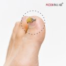 메디인 | 내성발톱 교정기 추천! 메디인랩 내성발톱 교정기 사용 후기