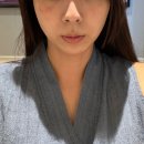 기미, 제모 걱정 끝 연신내 우태하 피부과 루비레이저 시술 후기 효과는?