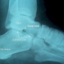 plantar fascia 족저근막의 기능, 특히 load bearing 체중의 14%를 담당. 이미지