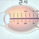 리얼스코프(주) | 부산 초고도근시 부등시안경 윙크 안경원에서 고민끝!!! 변색렌즈 안경으로 눈부심해결