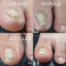 야시손톱 이미지