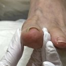 레푸스 잠실역점 내성발톱·무좀발톱·발각질·문제성발
